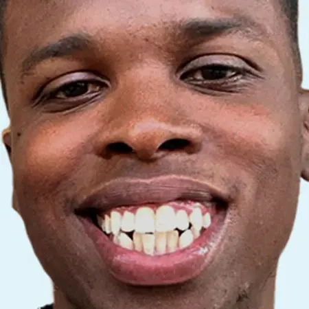 Photo-social-proof-young-man-smile-before-Invisalign-treatment