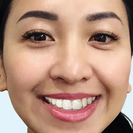 Photo-social-proof-young-woman-smile-after-Invisalign-treatment