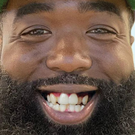 ugc-slider-before-man-with-beard-smile-before-Invisalign-treatment